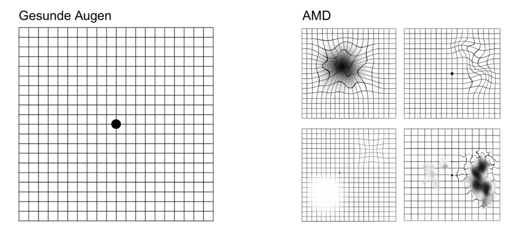 Infografik mit Gitternetzmustern: Links ein gleichmäßiges Raster mit Punkt („Gesunde Augen“), rechts fünf Raster mit Verzerrungen und Flecken („AMD“), die Sehstörungen zeigen.