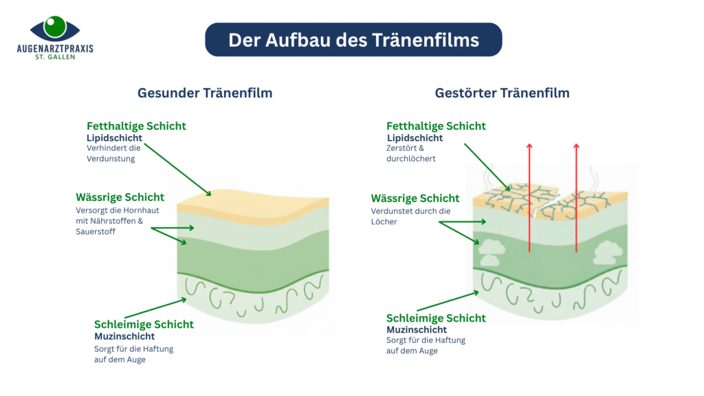 Zwei nebeneinanderstehende 3D-Grafiken zeigen den Vergleich eines gesunden und eines gestörten Tränenfilms mit je drei farblich abgesetzten Schichten: Lipidschicht (oben), wässrige Schicht (Mitte), Muzinschicht (unten). Beim gestörten Tränenfilm ist die Lipidschicht beschädigt, rote Pfeile zeigen Verdunstung.