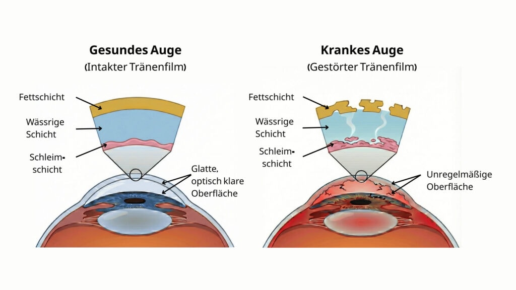 Vergleichsgrafik zweier Augen mit Fokus auf den Tränenfilm. Links ist ein gesundes Auge mit intakten Schichten (Fett, wässrig, Schleim), rechts ein krankes Auge mit gestörtem, aufgebrochenem Tränenfilm.