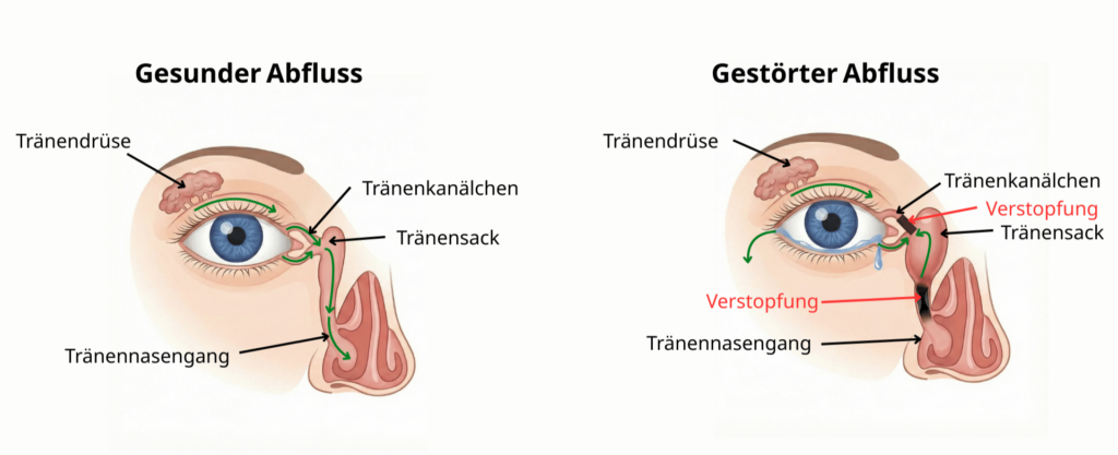 Grafik zeigt links den normalen Tränenabfluss vom Auge zur Nase, rechts eine gestörte Variante mit zwei roten Verstopfungsstellen. Pfeile markieren den Flussweg.