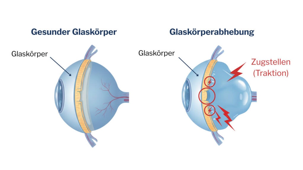Zwei Querschnittszeichnungen eines Auges: links ein intakter Glaskörper, rechts ein abgehobener Glaskörper mit markierten Zugstellen (Traktion) an der Netzhaut.