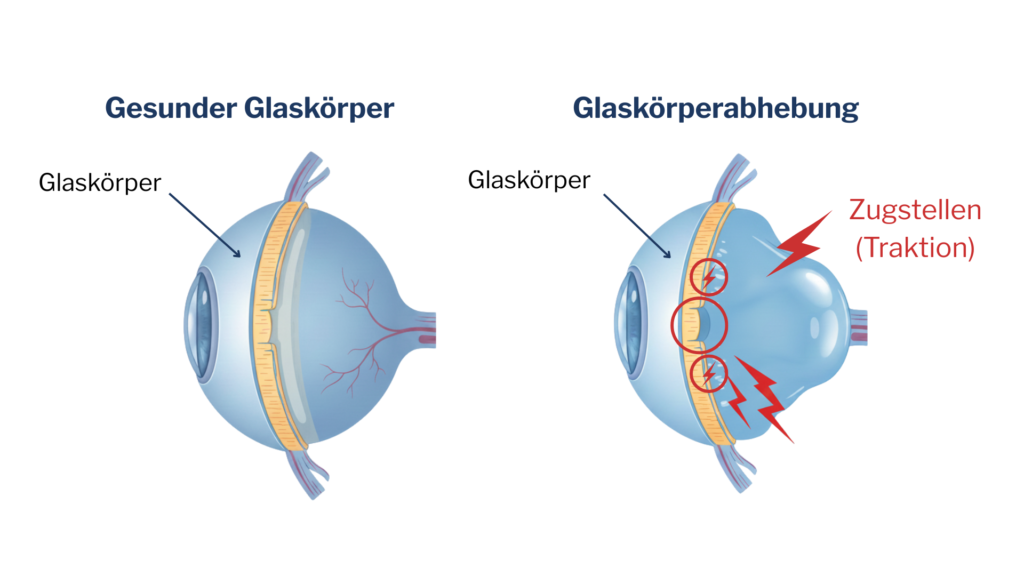 Zwei Querschnittszeichnungen eines Auges: links ein intakter Glaskörper, rechts ein abgehobener Glaskörper mit markierten Zugstellen (Traktion) an der Netzhaut.
