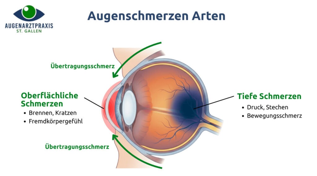 Infografik mit Querschnitt eines Auges und der Überschrift „Augenschmerzen Arten“. Markiert sind oberflächliche, tiefe und Übertragungsschmerzen mit Stichpunkten zu Brennen, Fremdkörpergefühl, Druck und Bewegungsschmerz.