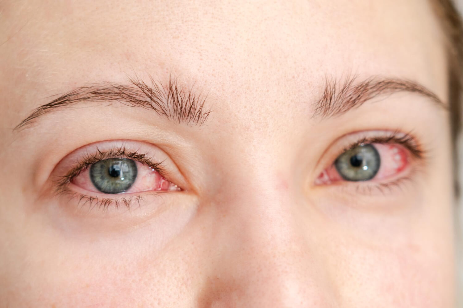 Nahaufnahme eines Gesichts mit Fokus auf beide Augen. Die Augen sind blaugrün, die Bindehaut ist gerötet, besonders an den inneren Augenwinkeln. Helle Haut mit sichtbaren Poren und feinen Augenbrauen.